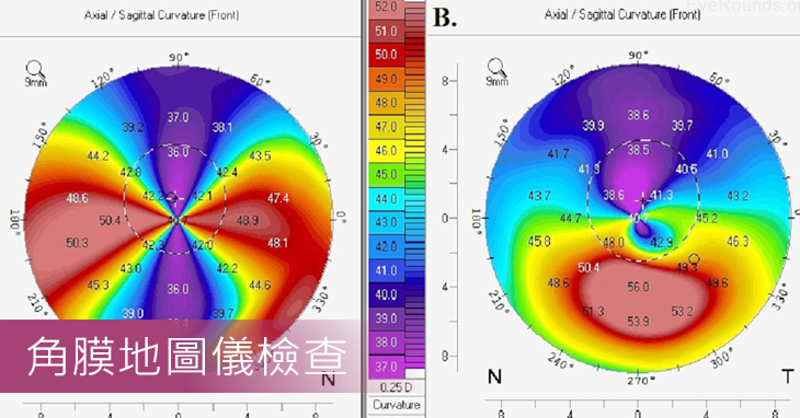 角膜地圖儀檢查