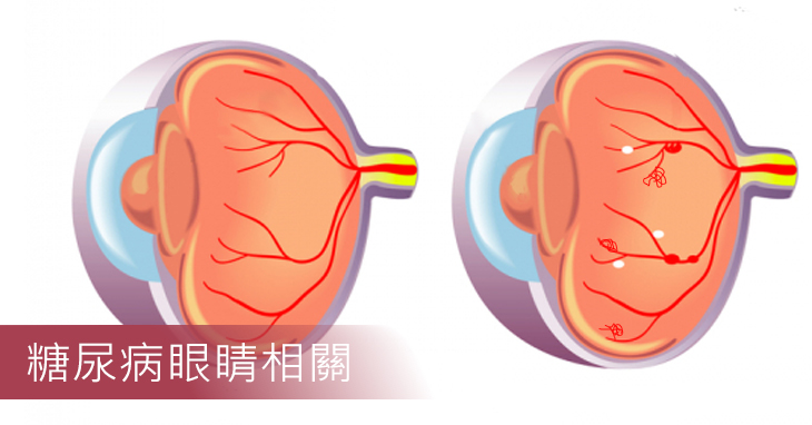 糖尿病眼睛相關