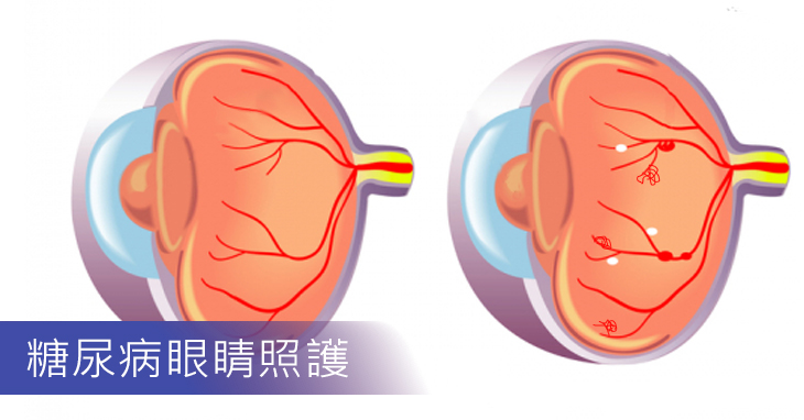 糖尿病眼睛照護