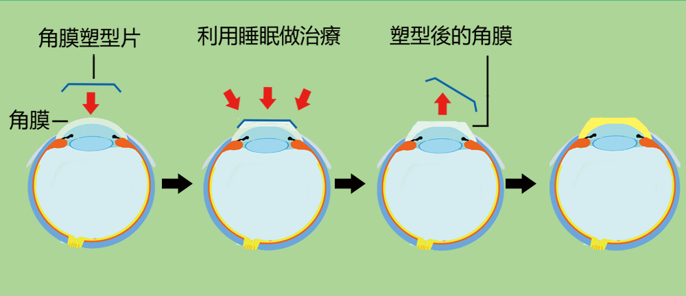 角膜塑型片原理