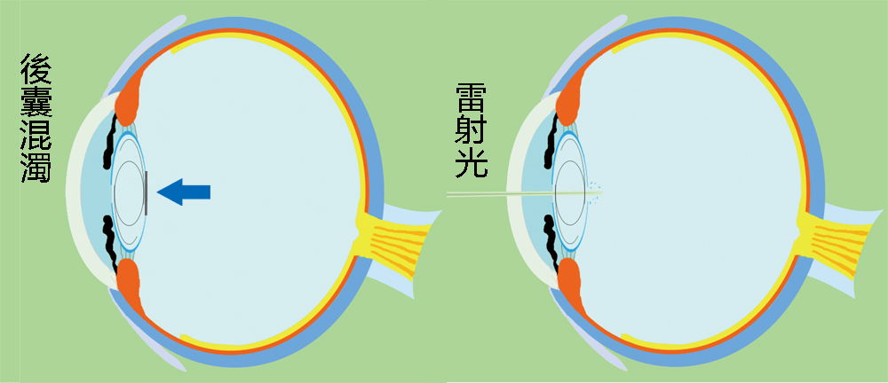 後囊雷射治療