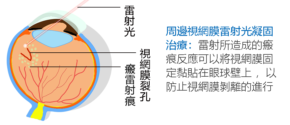 視網膜裂孔雷射凝固治療