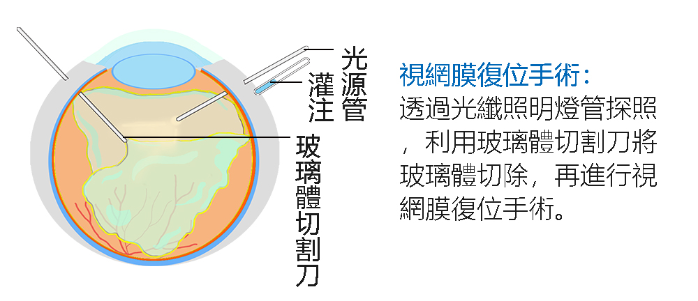 視網膜復位手術